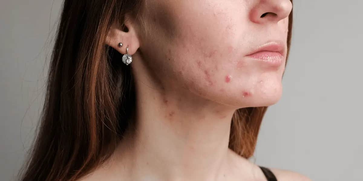 Banishing Hormonal Acne: A Comprehensive Guide to Clear Skin