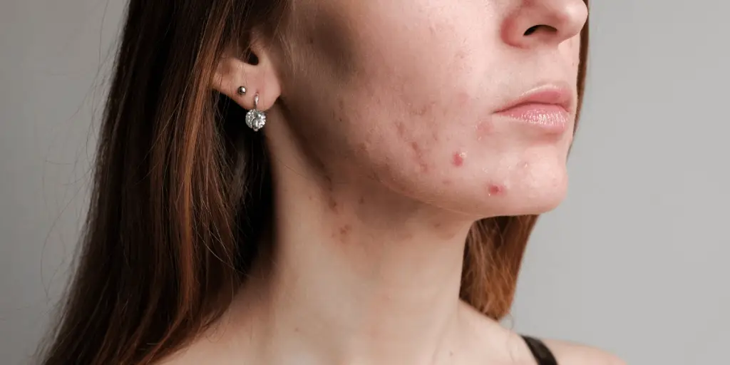 Hormonal Acne