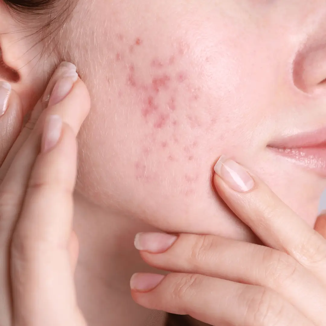 Understanding Hormonal Acne