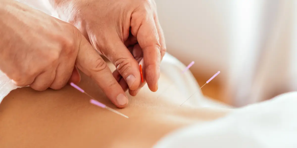 The Acupuncture Experience What to Expect
